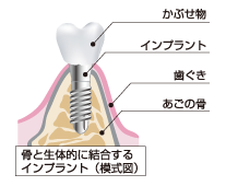 よしどめ歯科インプラント専門サイト インプラントとは