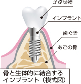 インプラントの構造