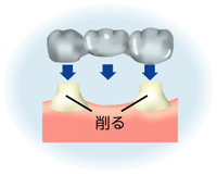 「ブリッジ」を用いた従来の治療法